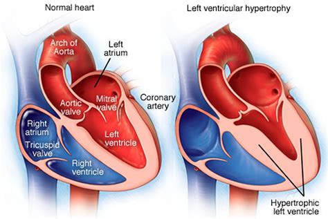 Left ventricular hypertrophy .